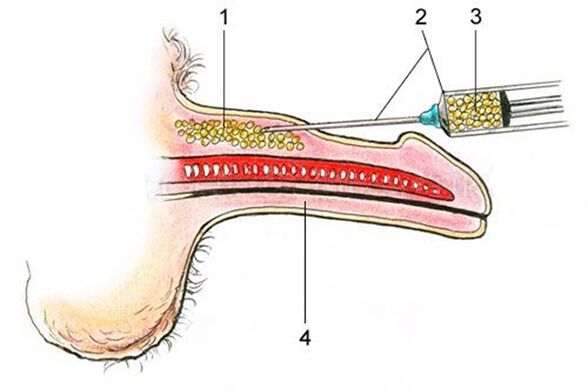 Lipofilling - pengenalan jaringan adiposa ke dalam batang penis