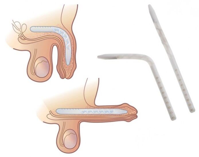 Falloplasty untuk meningkatkan anggota