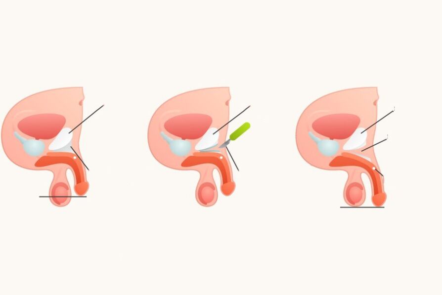 Ligamentotomy untuk meningkatkan penis