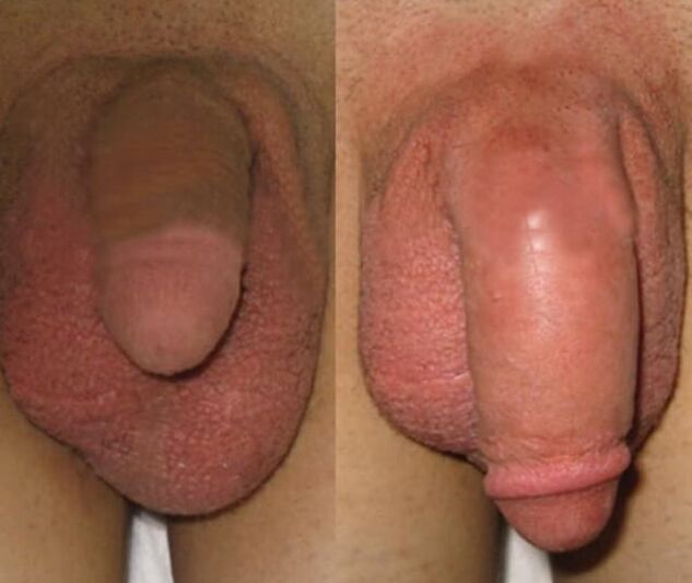 Hasil pemasangan matriks kolagen pada penis