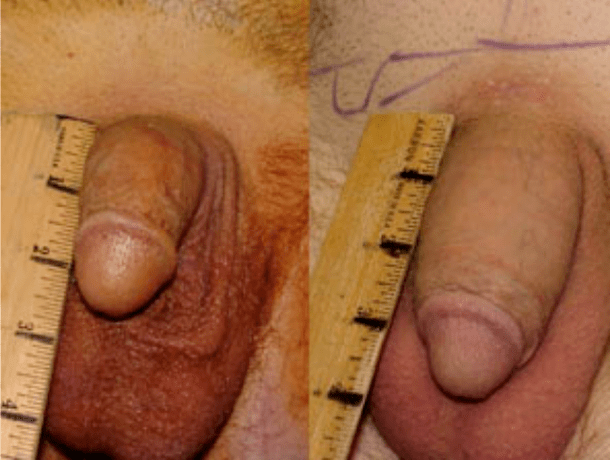 Sebelum dan sesudah lipofilling dan implantasi gel