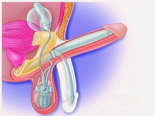 Pembesaran penis melalui prostesis penis