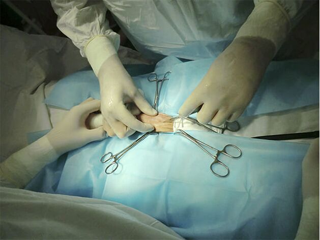 operasi pembesaran penis